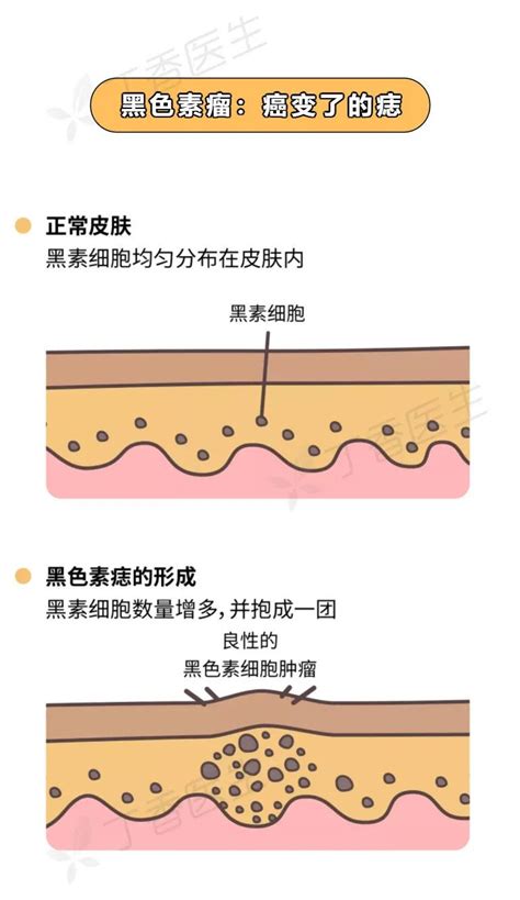 大痦子|痣也可能会癌变！长在 3 个地方要注意